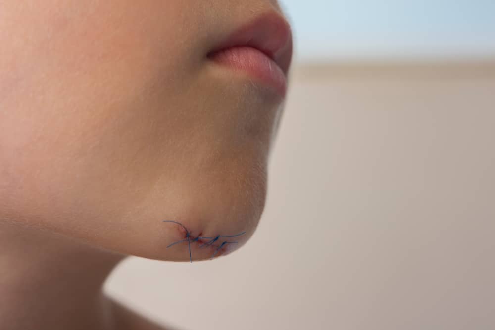 Laceration,With,Stitches,Of,The,Chin,Of,A,Child.,Close Stitches Arlington VA
